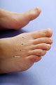 acupuncture treatment on the toes